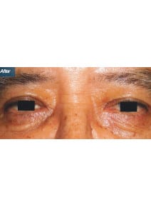Upper and Lower Eyelid Surgery after photo, close-up view (case 9147)
