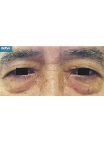 Upper and Lower Eyelid Surgery before photo, close-up view (case 9147)