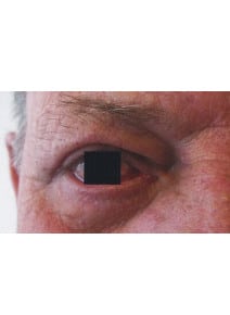 Upper Eyelid Surgery after photo, left view (case 9151)
