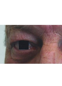 Upper Eyelid Surgery before photo, left view (case 9151)