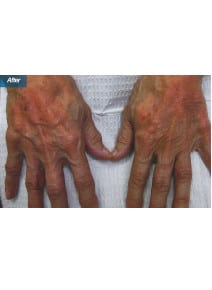 Radiesse Hands after photo, front view (case 9154)