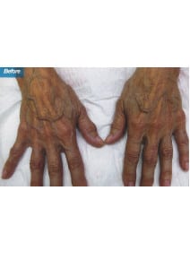 Radiesse Hands before photo, front view (case 9154)