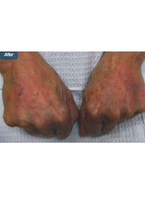 Radiesse Hands after photo, close-up view (case 9163)