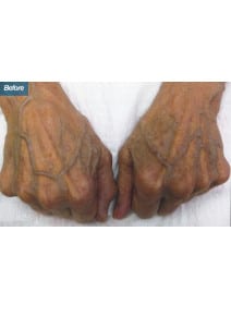 Radiesse Hands before photo, close-up view (case 9163)