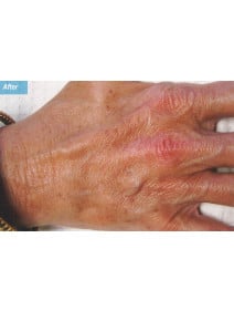 Radiesse Hands after photo, close-up view (case 9164)