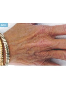Radiesse Hands before photo, close-up view (case 9164)