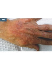 Radiesse Hands after photo, close-up view (case 9165)