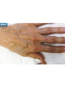 Radiesse Hands before photo, close-up view (case 9165)