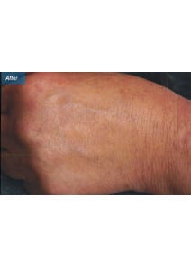 IPL after photo, close-up view (case 9173)