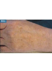 IPL before photo, close-up view (case 9173)