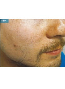 IPL after photo, oblique right view (case 9178)