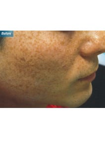 IPL before photo, oblique right view (case 9178)