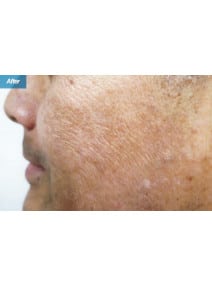 IPL after photo, left view (case 9182)