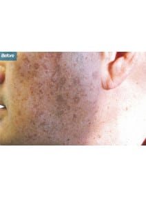 IPL before photo, left view (case 9182)