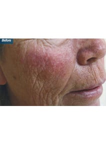 IPL before photo, oblique right view (case 9186)