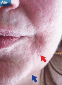 Marionettes and Jowls after photo, close-up view (case 9190)