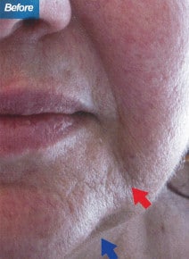 Marionettes and Jowls before photo, close-up view (case 9190)