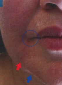 Marionettes and Jowls after photo, close-up view (case 9194)
