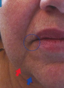 Marionettes and Jowls before photo, close-up view (case 9194)