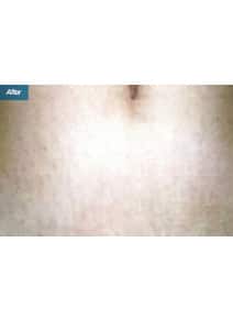 Microneedling after photo, front view (case 9200)
