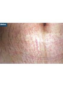 Microneedling before photo, front view (case 9200)