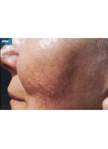 Microneedling after photo, left view (case 9201)