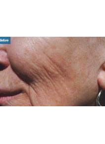 Microneedling before photo, left view (case 9201)