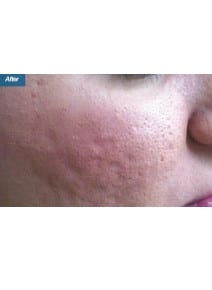 Microneedling after photo, right view (case 9202)