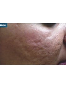 Microneedling before photo, right view (case 9202)