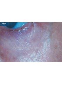 Microneedling after photo, left view (case 9203)