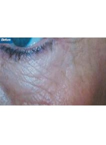 Microneedling before photo, left view (case 9203)