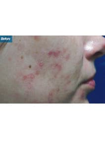 Microneedling before photo, right view (case 9204)