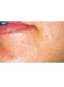 Microneedling after photo, left view (case 9205)