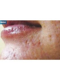 Microneedling before photo, left view (case 9205)
