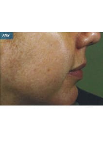 Microneedling after photo, right view (case 9206)