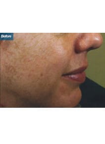 Microneedling before photo, right view (case 9206)