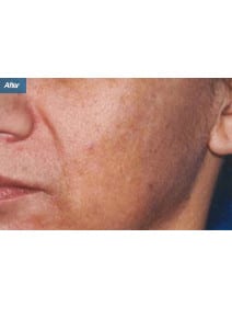 Microneedling after photo, oblique left view (case 9207)