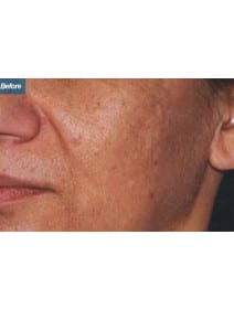 Microneedling before photo, oblique left view (case 9207)