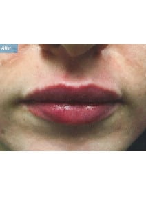 Restylane after photo, close-up view (case 9232)