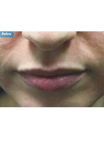 Restylane before photo, close-up view (case 9232)