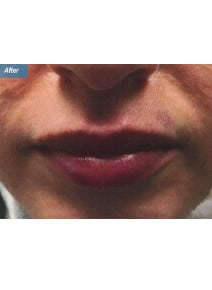 Restylane after photo, close-up view (case 9232)