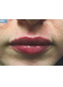 Restylane before photo, close-up view (case 9232)