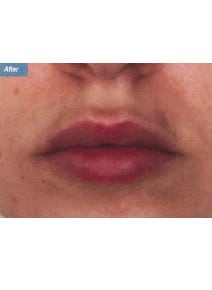 Restylane after photo, close-up view (case 9232)