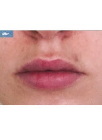Restylane before photo, close-up view (case 9232)