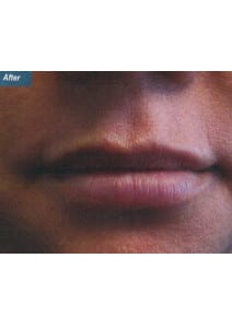 Restylane after photo, close-up view (case 9239)