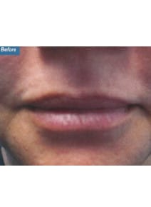 Restylane before photo, close-up view (case 9239)