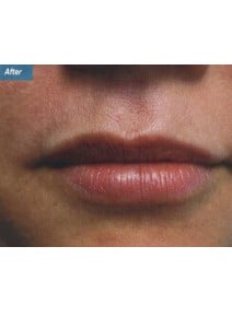 Restylane after photo, close-up view (case 9239)