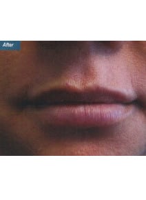 Restylane before photo, close-up view (case 9239)