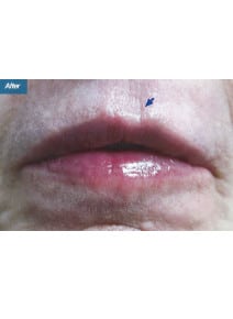 Restylane after photo, close-up view (case 9242)