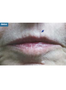 Restylane before photo, close-up view (case 9242)